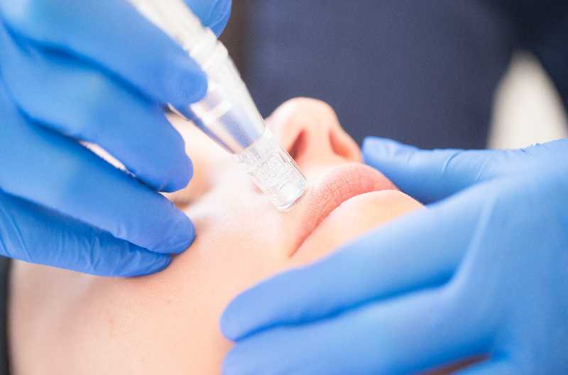 nanoneedling ansigtsbehandling beautysolution